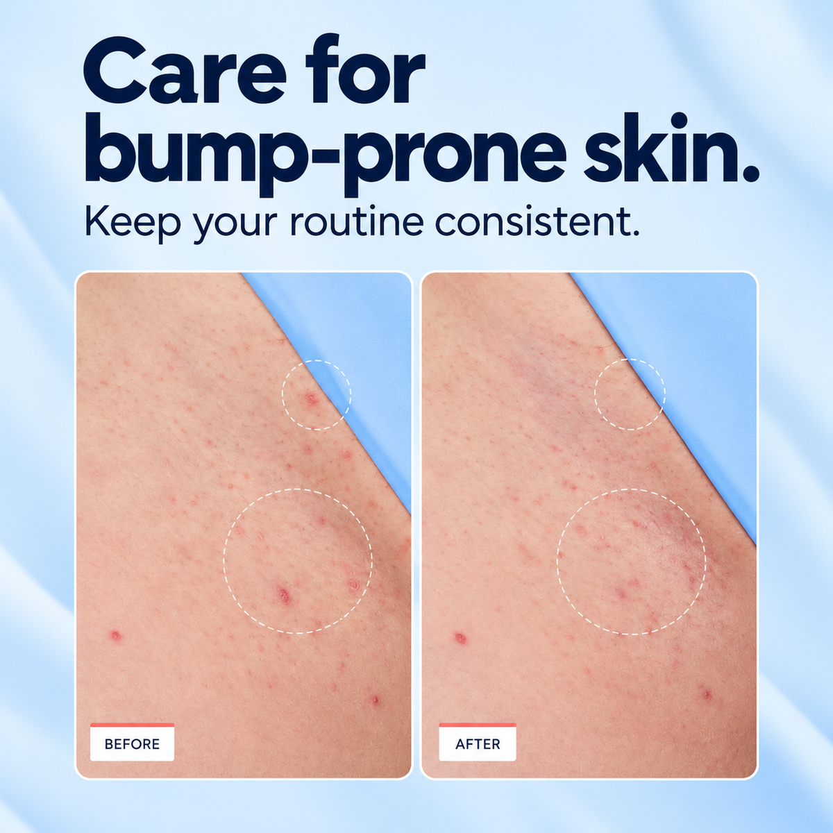 Bump-prone skin comparison